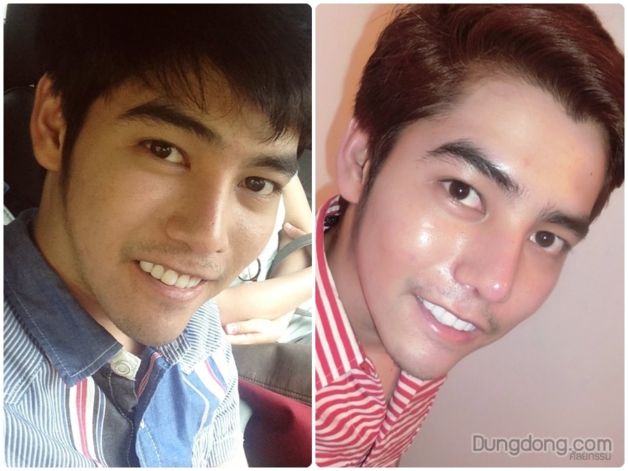 รีวิวเสริมจมูกผู้ชาย