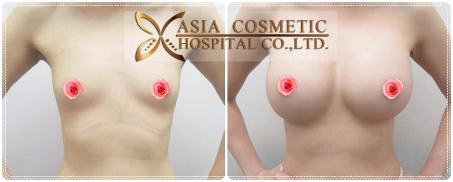 ทำศัลยกรรมเสริมหน้าอก