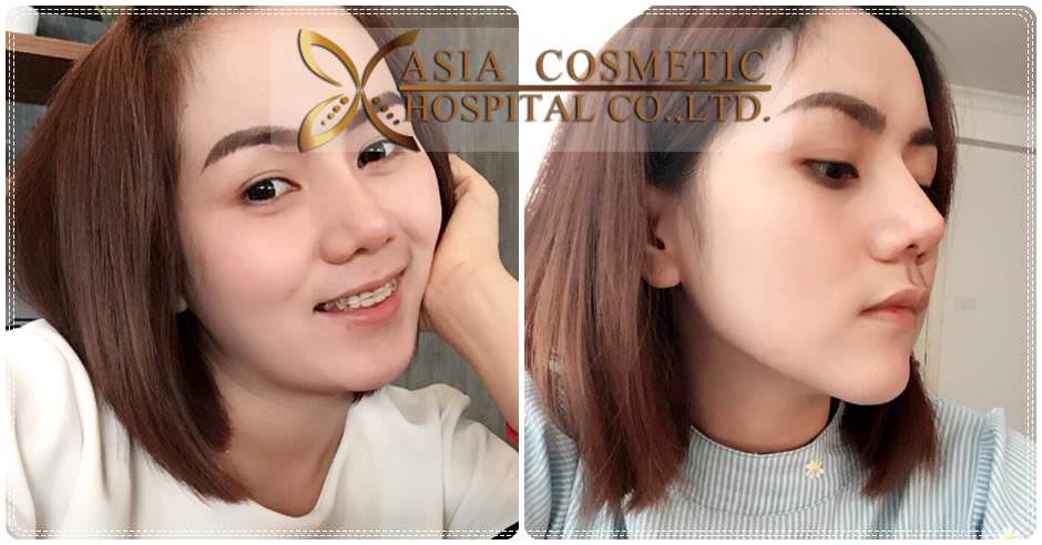 รีวิวศัลยกรรมคาง-เสริมคาง-โรงพยาบาลเอเซีย