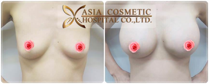 รูปรีวิวเสริมหน้ากับโรงพยาบาลเอเซีย