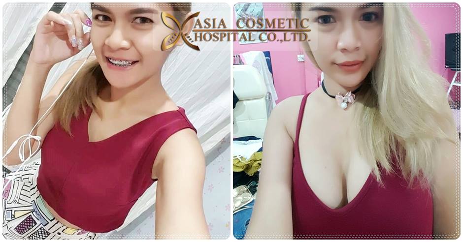 รีวิวศัลยกรรมเสริมหน้าอก 2019