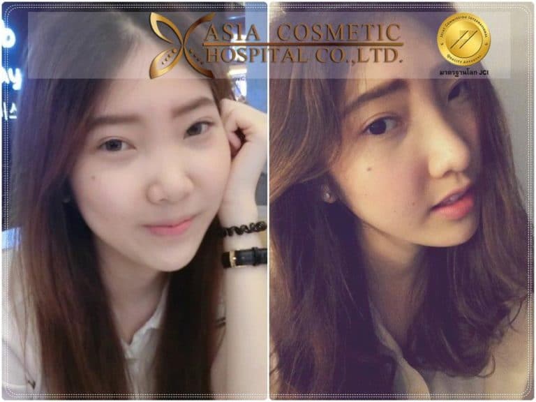 การทำศัลยกรรมเสริมจมูก