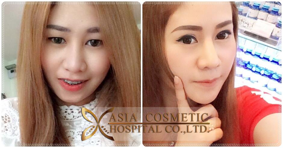 รีวิวการเสริมคาง