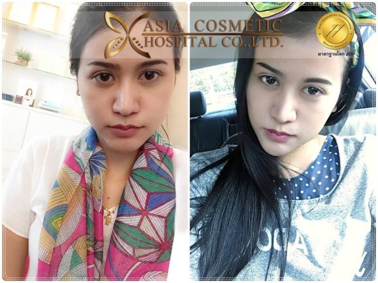 รีวิวประสบการณ์เสริมคาง