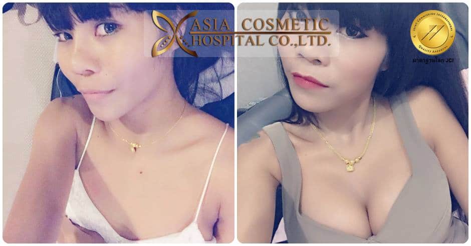 รีวิวเสริมหน้าอกใหม่