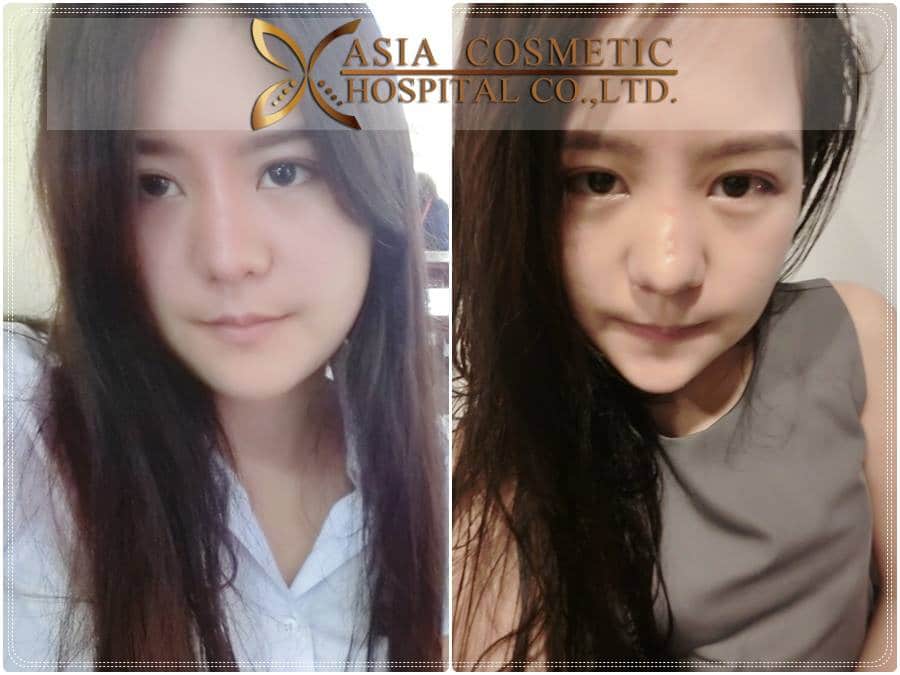 ตัดกรามเหลากราม