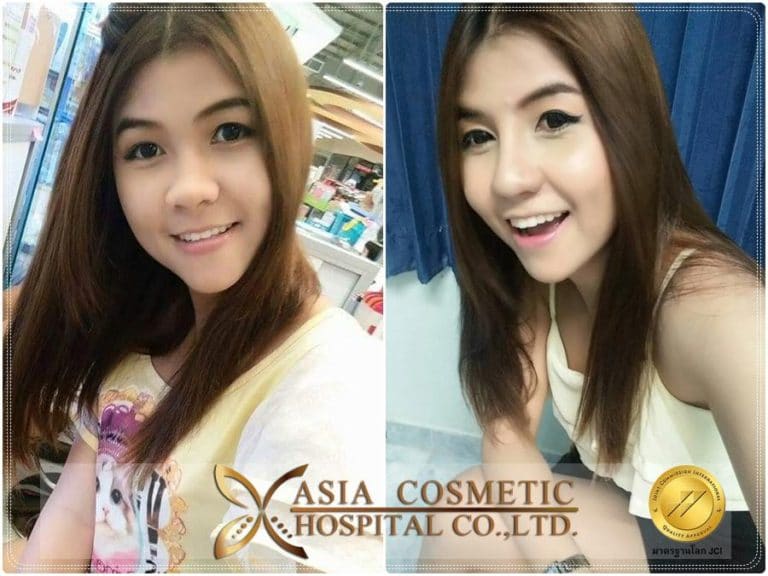 ศัลยกรรมเสริมจมูก