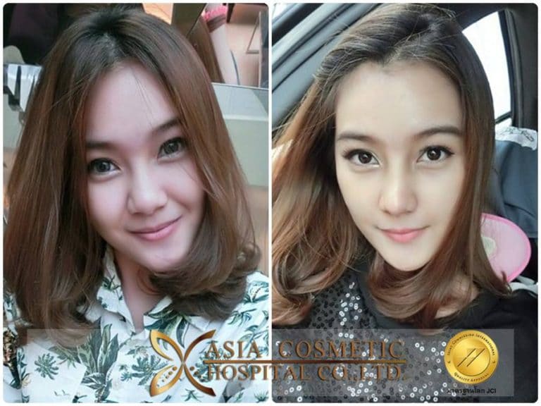 เสริมจมูก