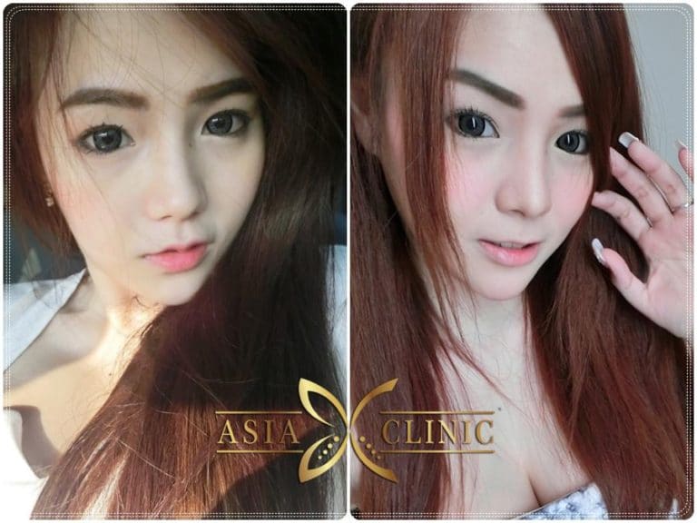 รีวิวเสริมจมูก 3 เดือน