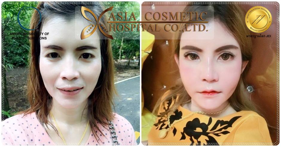 ยุบโหนกแก้ม