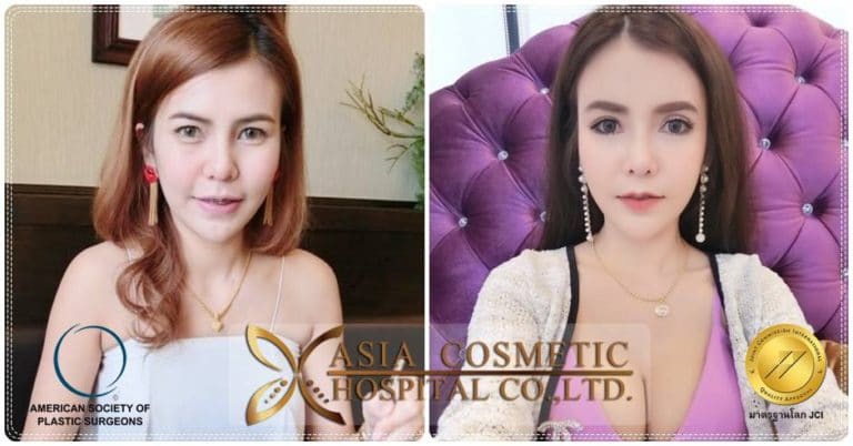 ยุบโหนกแก้ม