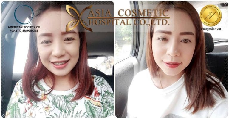 รีวิวเสริมจมูก