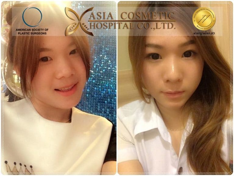เสริมจมูกสวย