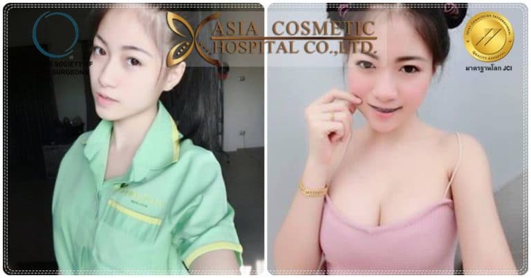 เสริมหน้าอก