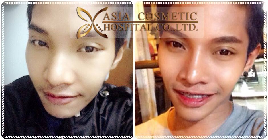 เสริมจมูก หมอทนงศักดิ์