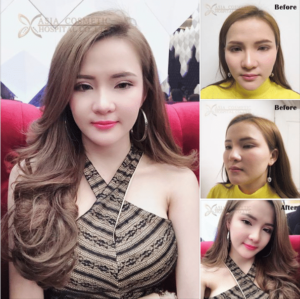 ยุบโหนก