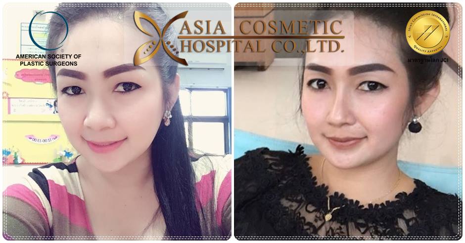 รีวิวเสริมจมูก
