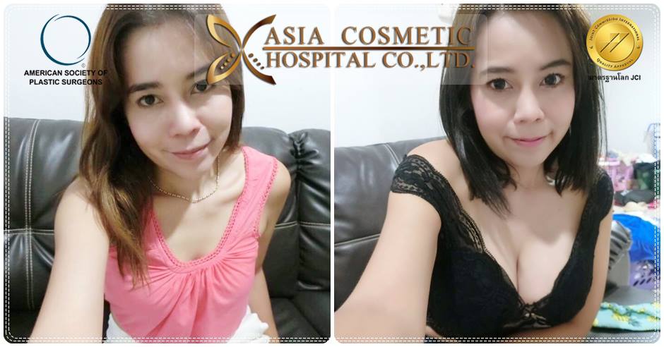 เสริมหน้าอกสวยๆ
