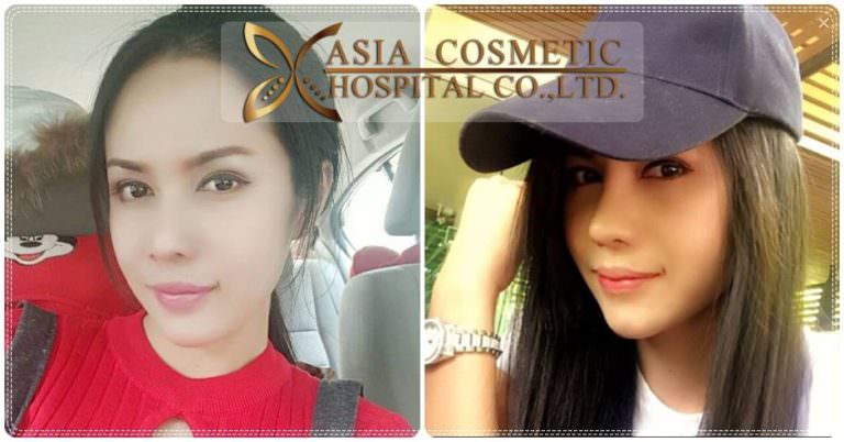รีวิวแก้จมูก-แก้จมูกสวยมาก
