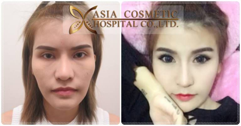 ศัลยกรรมยุบโหนกแก้ม