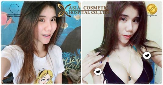 ทำหน้าอกใหม่