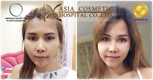 ปรับรูปหน้า ยุบโหนก ตัดกราม