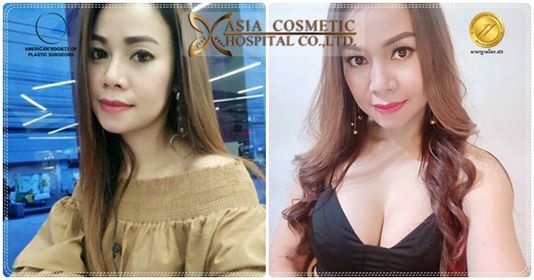รีวิวเสริมหน้าอก ครบ5เดือน