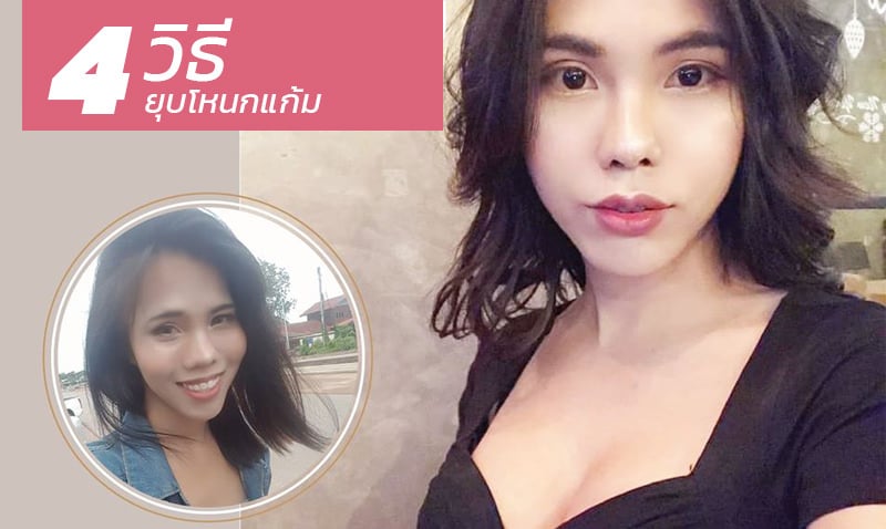 ยุบโหนกแก้ม