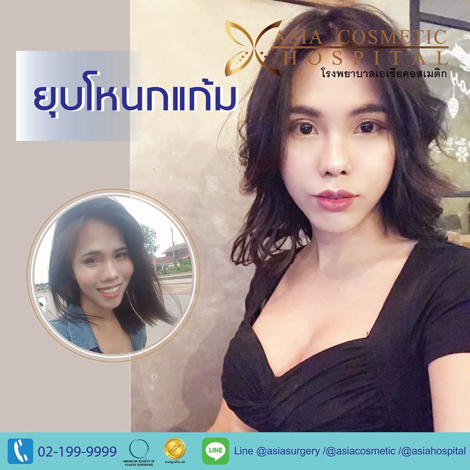 รีวิวยุบโหนกแก้ม