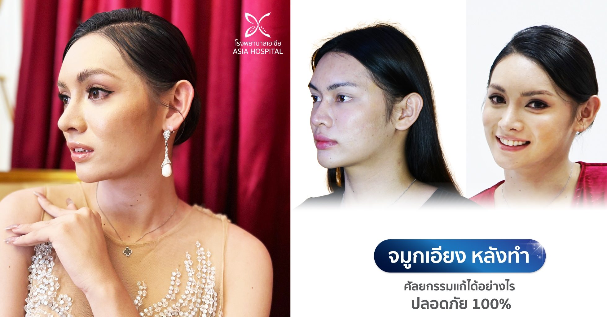 แก้จมูกรีวิว-แก้จมูกเอียง