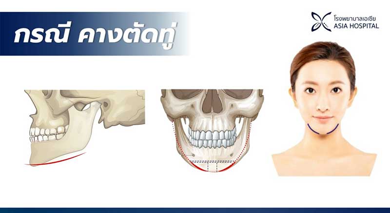 คางทู่-หน้าสั้น-วีไลน์