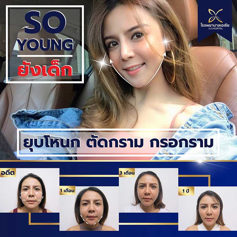 ยุบโหนก-ตัดกราม