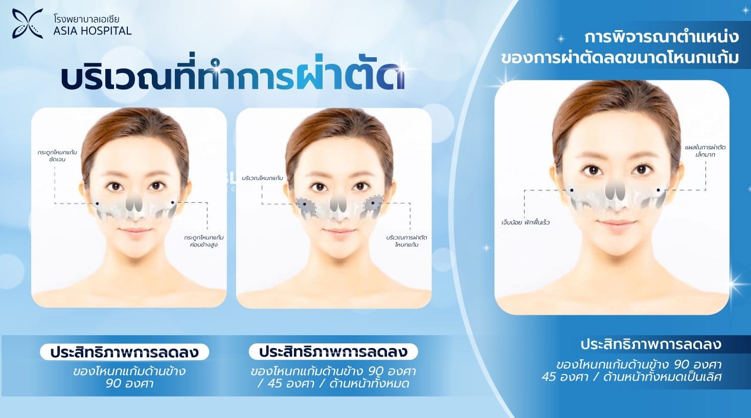 ผ่าตัดยุบโหนกแก้ม-ลดโหนกแก้ม
