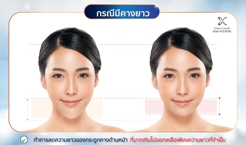 วีไลน์-คางยาว