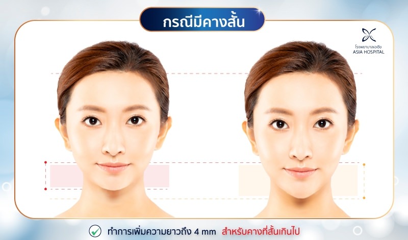 วีไลน์-คางสั้น
