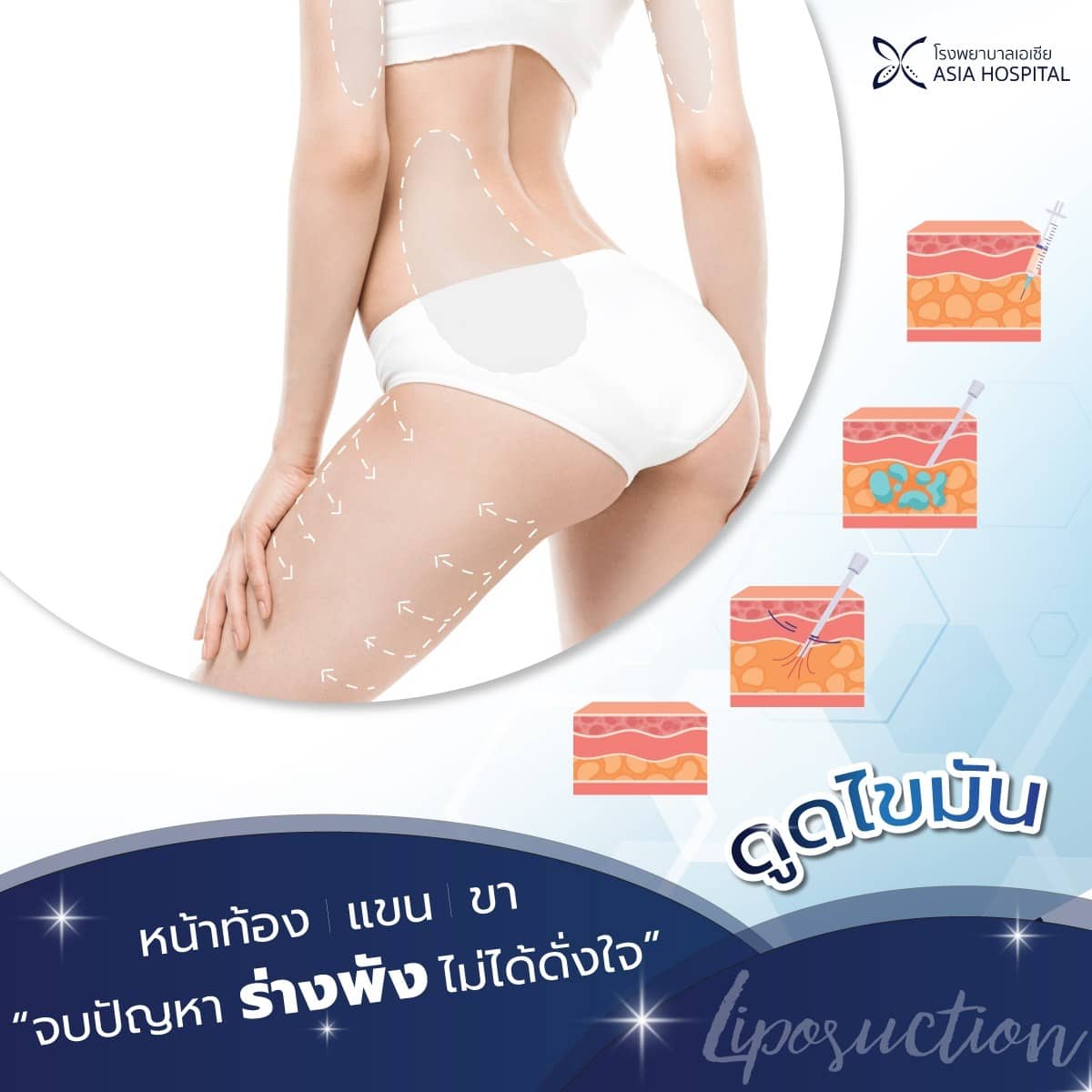 ดูดไขมัน-ราคา
