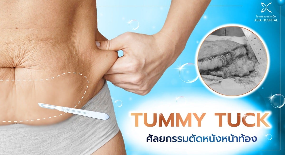 ตัดหนังหน้าท้อง