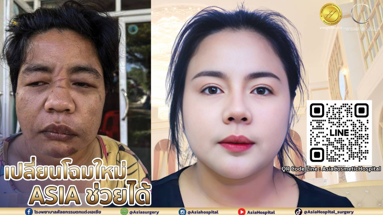 น้องเอ ทหารรับใช้ ก่อนทำศัลยกรรม