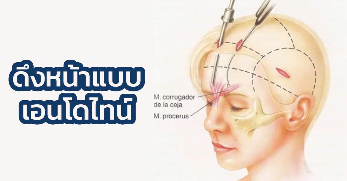 ดึงหน้า-endotine