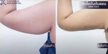 การตัดไขมันท้องแขนคืออะไร และเหมาะกับใคร