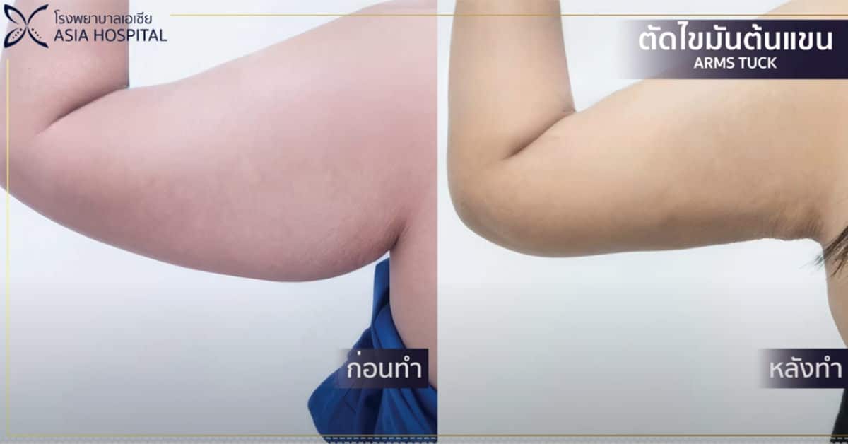 ตัดไขมันต้นแขน