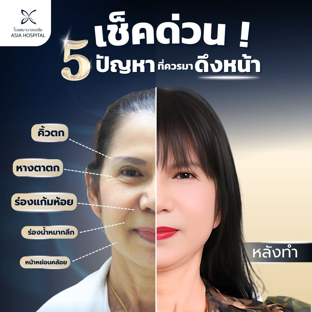 ดึงหน้า-เอนโดไทน์