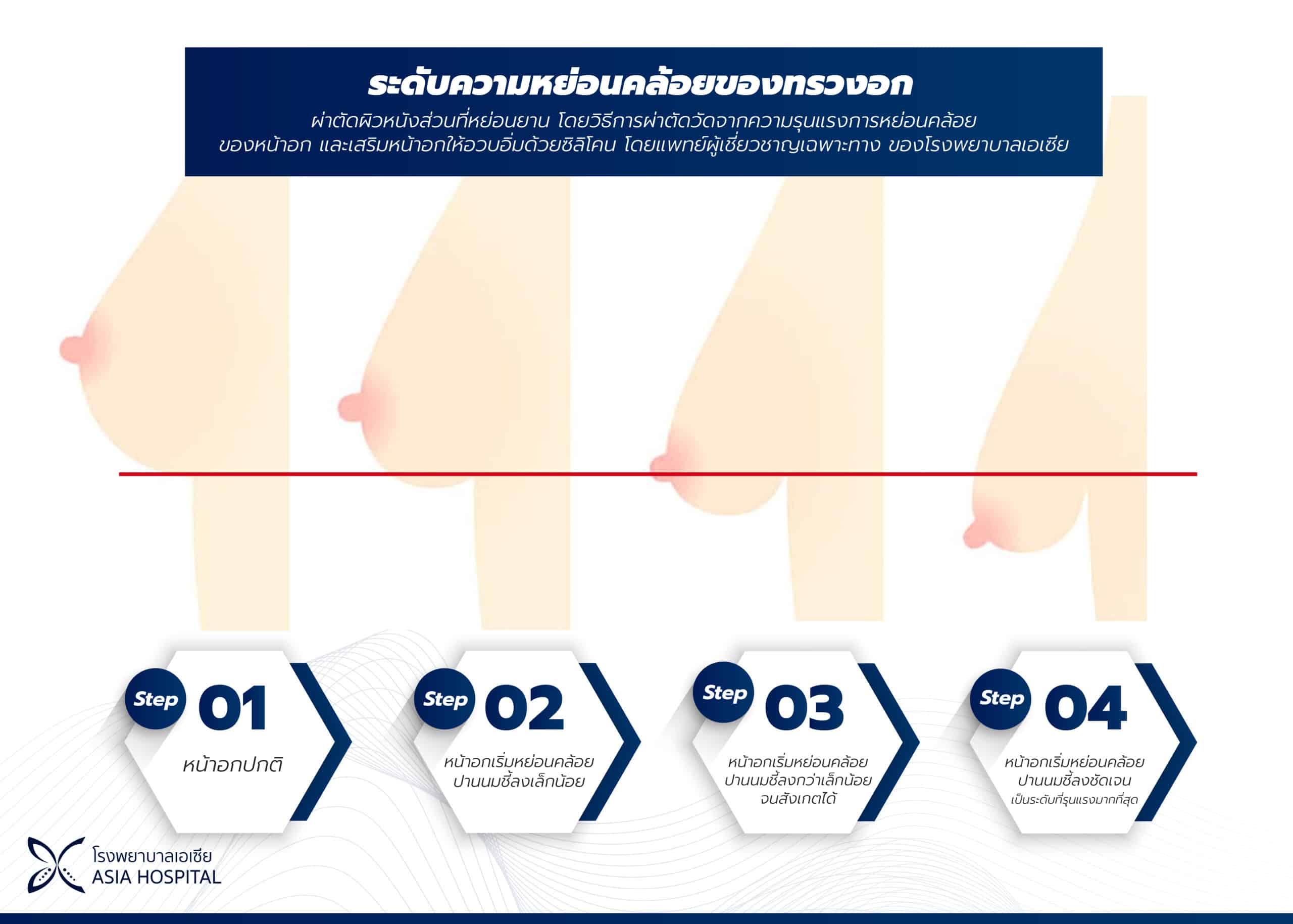 ระดับความหย่อนคล้อยหน้าอก