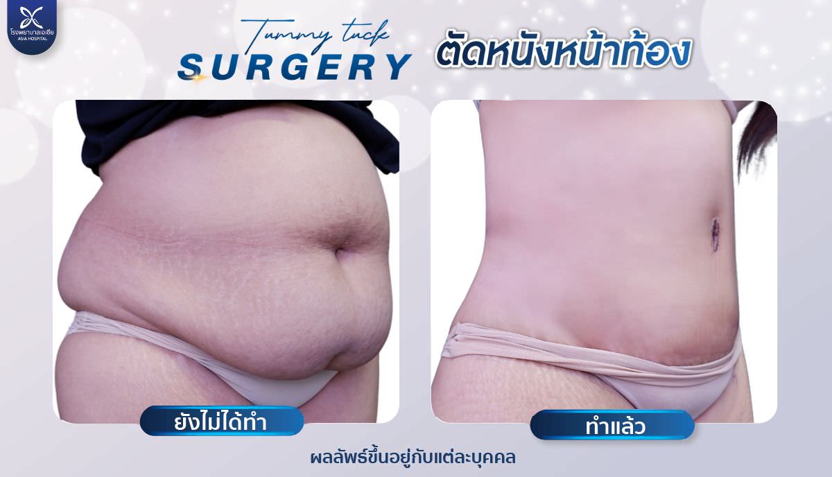 Tummy Tuck