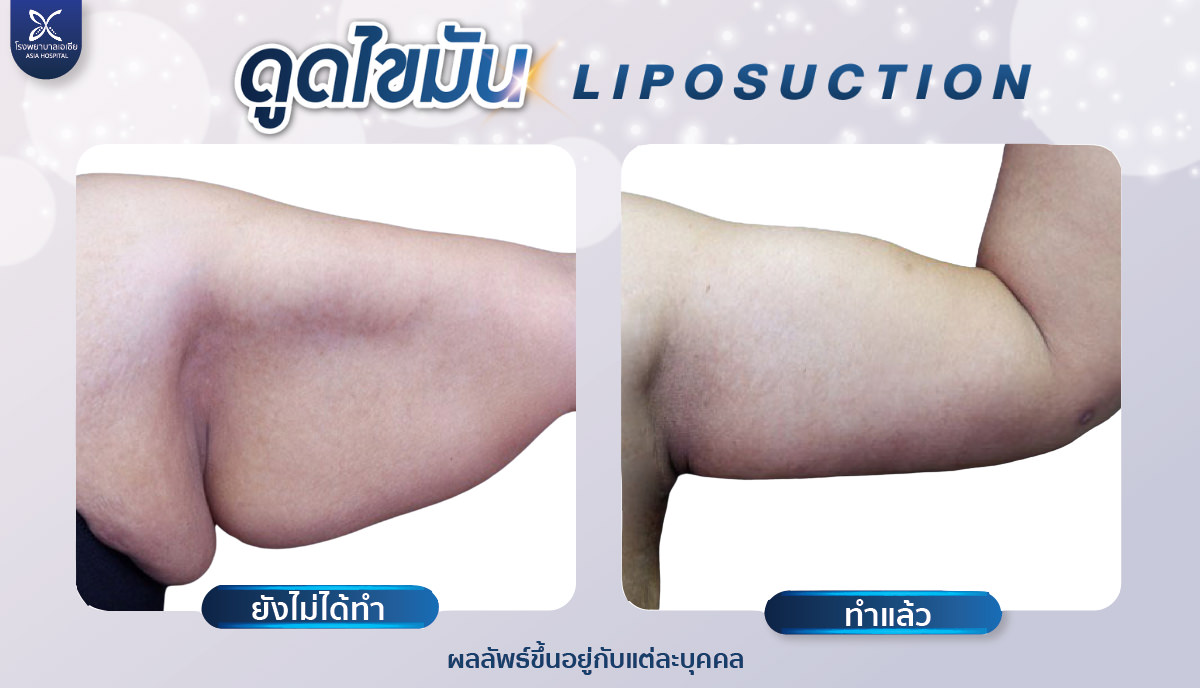 arm iposuction ดูดไขมันต้นแขน