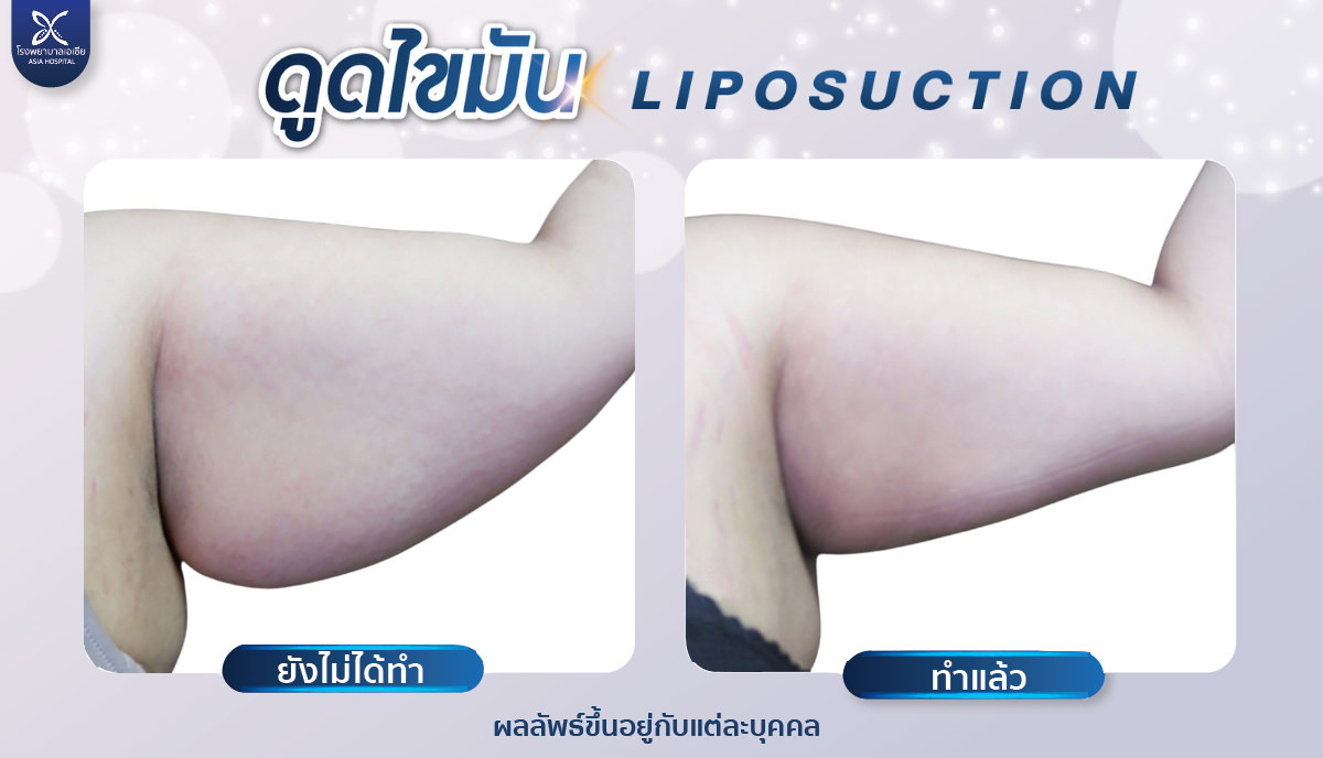 ศัลยกรรมดูดไขมัน-ดูดไขมันต้นแขน