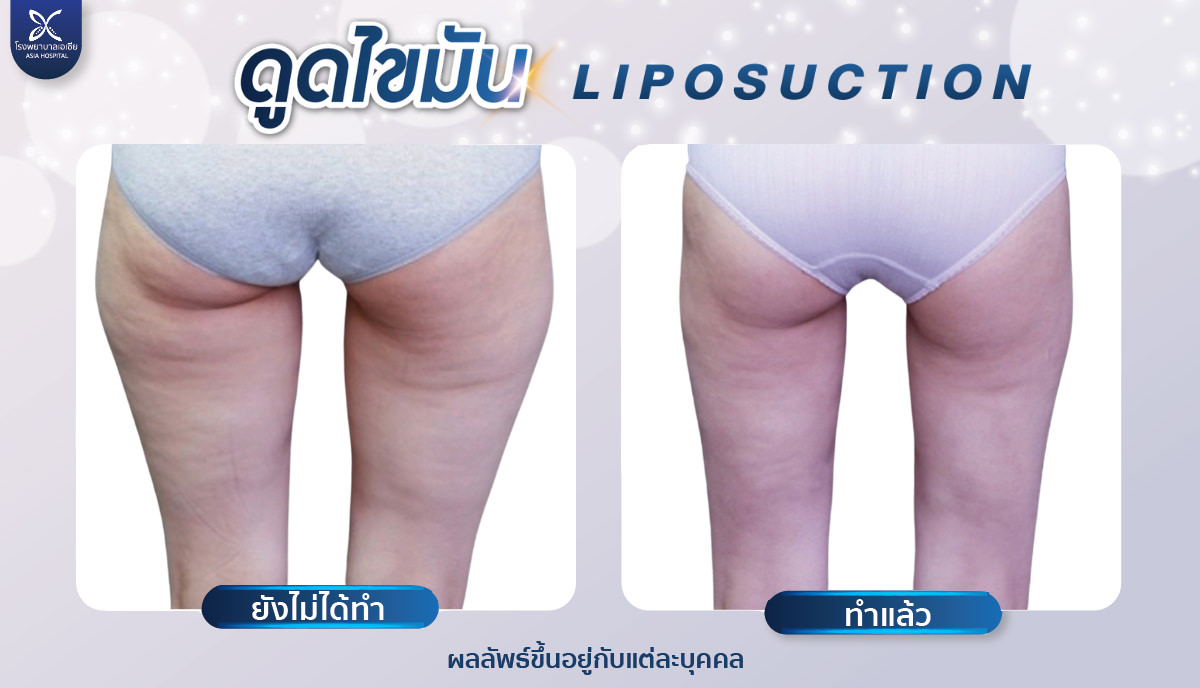 ดูดไขมันต้นขา โรงพยาบาลเอเซีย