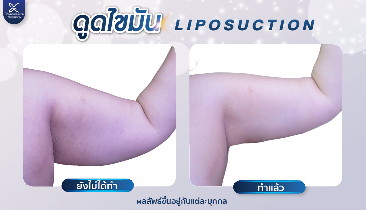 liposuction ดูดไขมันต้นแขน โรงพยาบาลเอเซีย