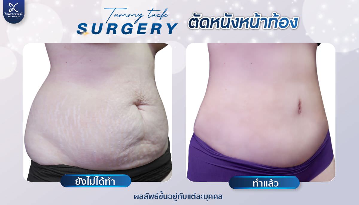 tummytuck-ตัดหนังหน้าท้อง