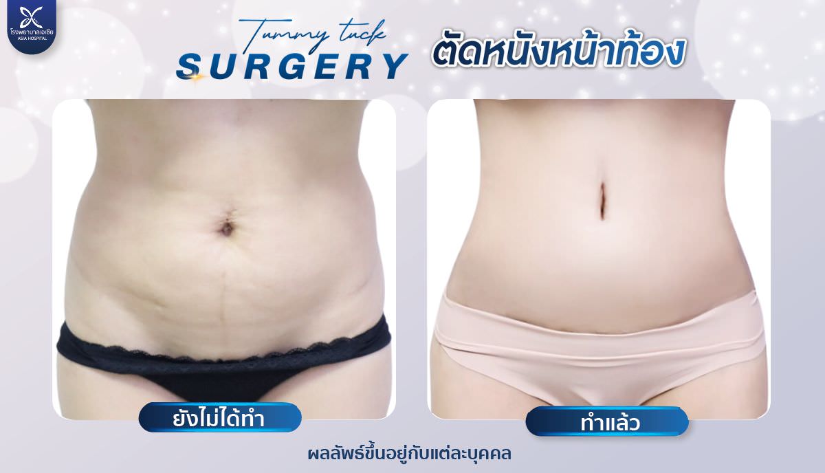 tummytuck-ตัดไขมันหนังหน้าท้อง